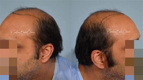 Hair Transplant In Extensive Pattern Baldness Darling Buds Clinic India Youtube