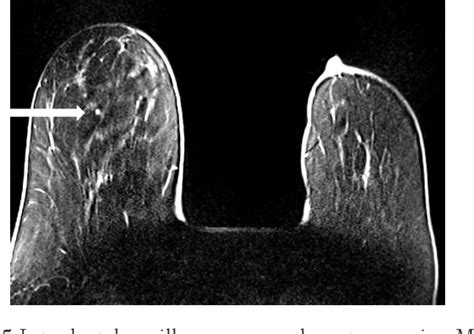 Figure 1 From Intraductal Papillomas Of The Breast Semantic Scholar