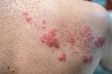 How To Recognise Early Signs Of Shingles Repeat Prescriptions Ordered Online Nhs Pharmacy