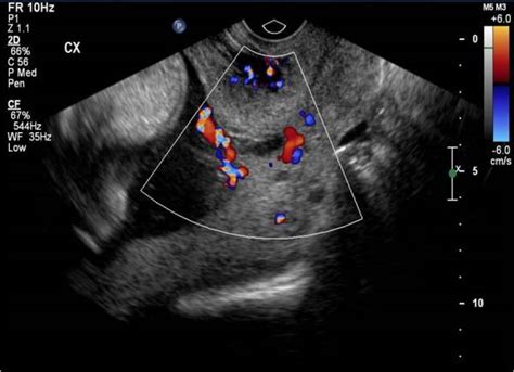 Vasa Previa | RADIOLOGYPICS.COM