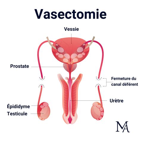 Vasectomie Opération de stérilisation masculine Pr Messas