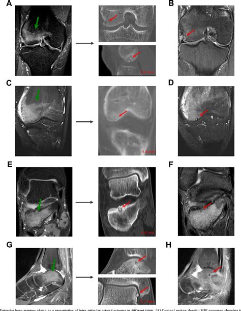 Figure 1 From Intra Articular Osteoid Osteoma Accompanied By Extensive