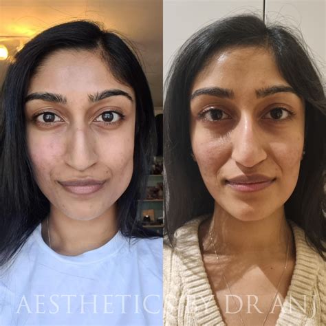 Bruxism Jawline Slimming — Aesthetics By Dr Anj