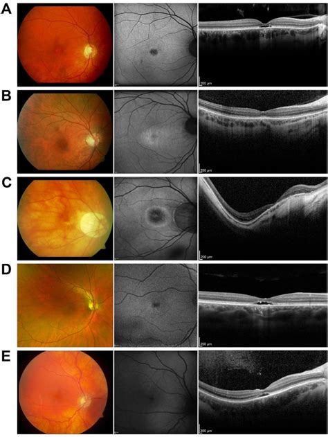 Figure From Gucy D Related Retinal Dystrophy With Autosomal Dominant