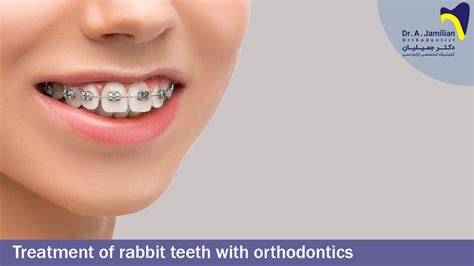 Treatment Of Rabbit Teeth With Orthodontics - Dr Jamilian