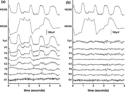 A Five Second Epoch Of Raw Eog And Eeg Signals Containing Prominent Download Scientific