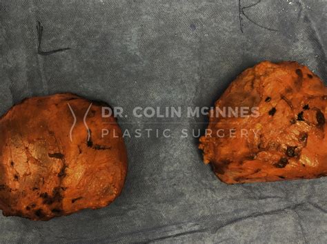 Breast Implant Removal & Capsulectomy | Dr. Colin McInnes