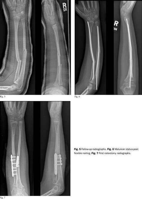 Figure From Corrective Osteotomy And Physeal Bar Resection For Distal