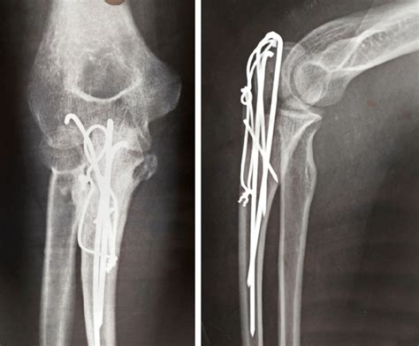 Case Anteroposterior And Lateral Radiograph Of The Elbow At The Final