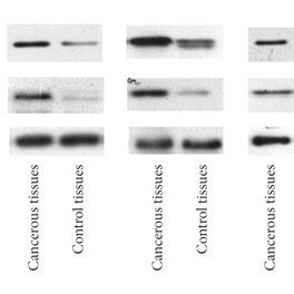 The Levels Of Ki67 And Sox2 In Control And Cancer Tissues Detected By