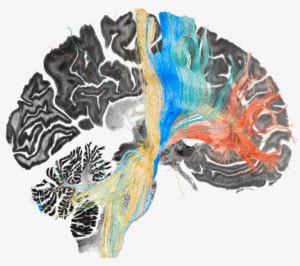 Utiliser La Stimulation C R Brale Profonde Pour Cartographier Les