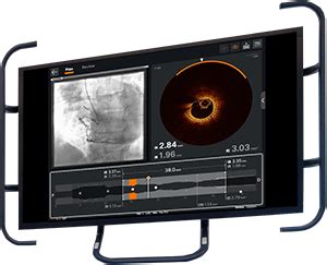 Intravascular Imaging Abbott