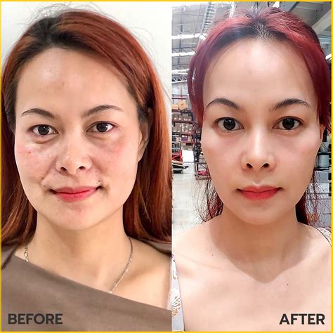 รีวิวฉีดฟิลเลอร์คาง Jiin Clinic Thailand