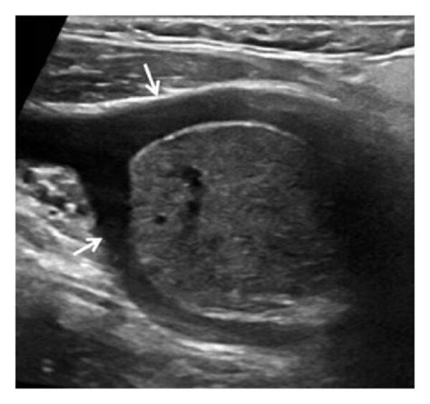 Gray Scale Ultrasound A Shows Well Defined Solid Mass That Causes