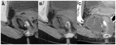 Longitudinal Change Of The Sacrococcygeal Mature Teratoma A 10 Years