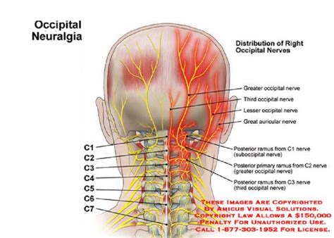 23 best Occipital Neuralgia images on Pinterest | Occipital neuralgia, Chronic pain and Fibromyalgia