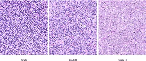 Histological appearance of the various grades of follicular lymphoma ...