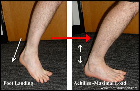 Achilles Tendon Rupture Footeducation