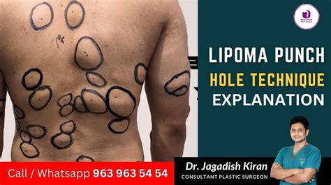 How To Get Rid Of Fat Lumps In Body Causes Of Lipoma And Treatment