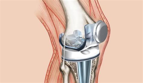 Revision Joint Replacement Surgeries Dr Praneeth Reddy C V