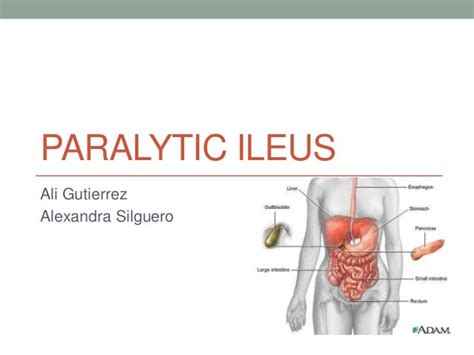 Paralytic ileus