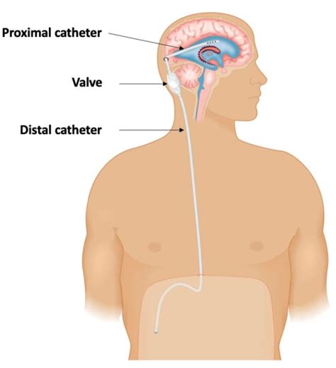 Neuronavigation And Laparoscopy Guided Ventriculoperitoneal Shunt