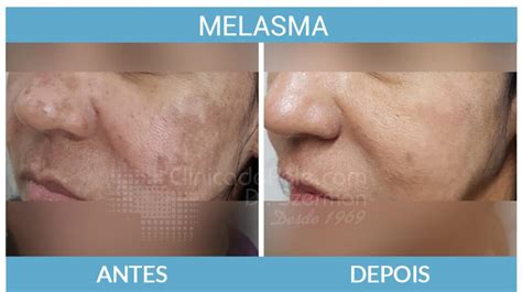 Melasma Antes E Depois Veja O Resultado Do Tratamento Laser CO2