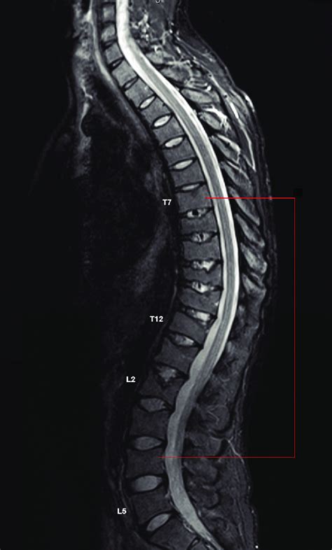 MRI of the thoracic and lumbar spine. | Download Scientific Diagram