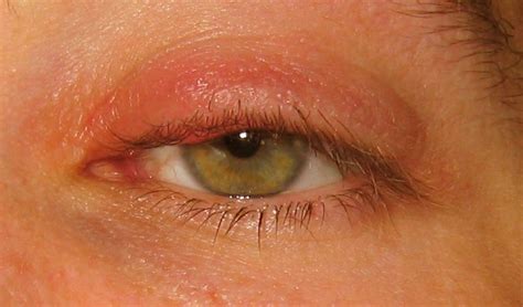 👉 Stye - Pictures, Contagious, Symptoms, Causes, Treatment (November 2021)