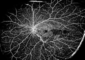 Retinal Vein Occlusion The Retina Clinic 2024