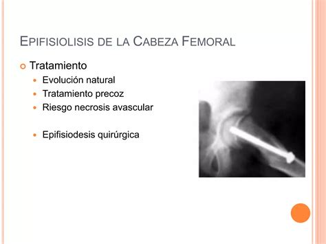 Patolog A De La Cadera Infantil Ppt