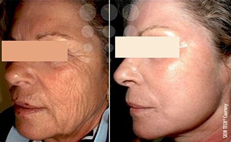 Phenol Peels (Deep Peels) for deep wrinkles Southampton Hampshire