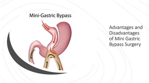 Advantages And Disadvantages Of Mini Gastric Bypass Surgery Ppt