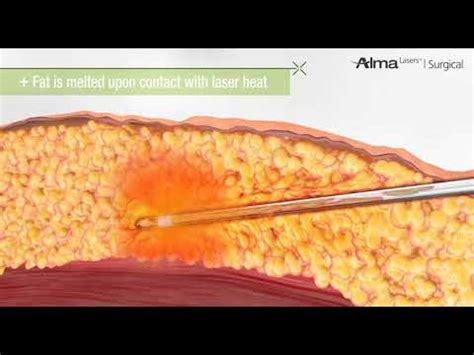 Laser Liposuction - YouTube