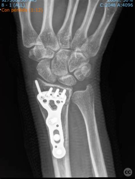 Distal Radius Fracture Osteosynthesis