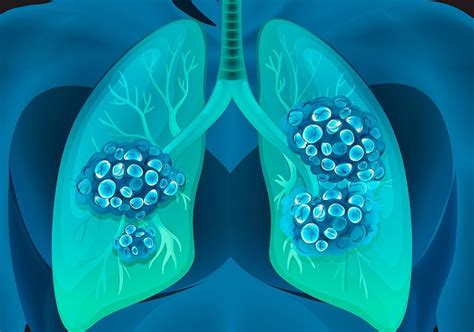 Stages Of Lung Cancer Booking Health