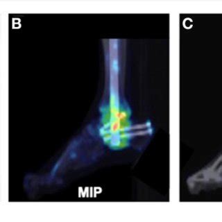 Imaging Assessment Of A 49 Year Old Female Patient With A History Of