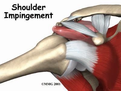 Fisio Fit Fisioterapia En El S Ndrome Subacromial