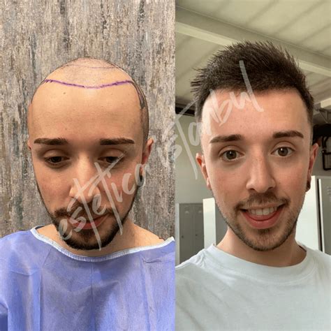 Hair Transplant Turkey Before After Estetica Istanbul