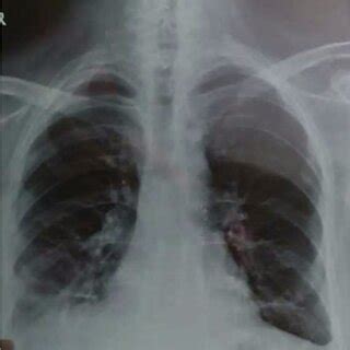 AD Chest Xray And Computed Tomography Of The Thorax After Almost A