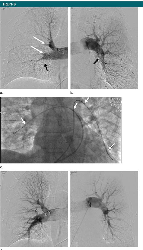 Table From Stratification Imaging And Management Of Acute Massive