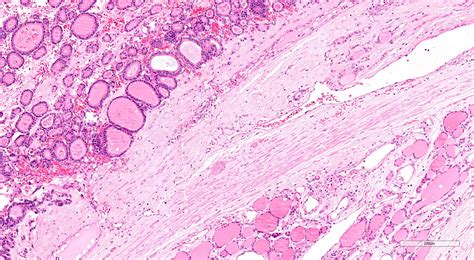 Thyroid Adenoma Histology