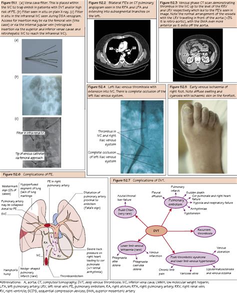 Complications of DVT | Thoracic Key