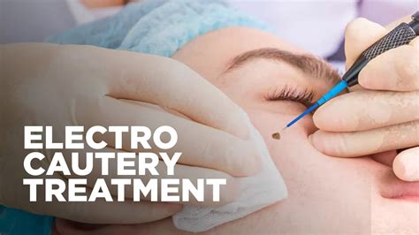 Electro Cautery Treatment By Alkhaleej Clinics Youtube