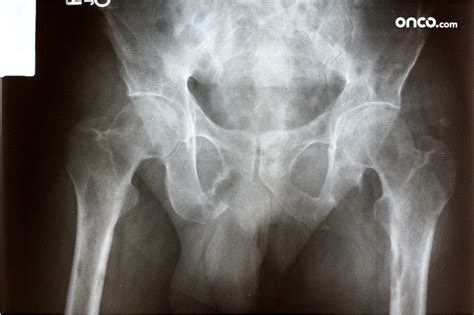 Causes of Bone Cancer | Onco.com | Risk Factors