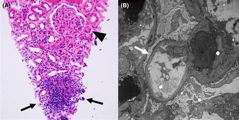 Renal Biopsy Finding A Light Microscopy [lm] ×20 Tubules Reveal