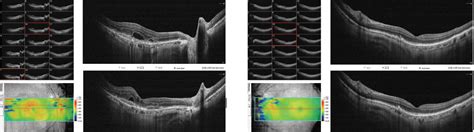 Subretinal Fluid Associated With Vision Function Improvement In Namd