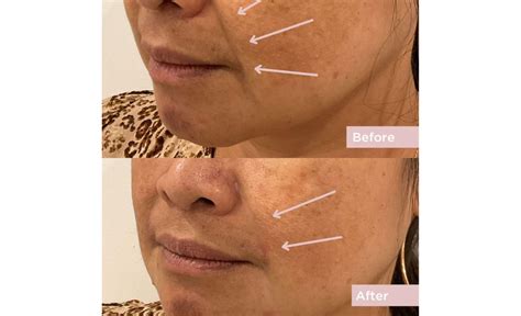 Nasolabial Fold Filler Dermal Fillers Contour Clinics Sydney And Brisbane