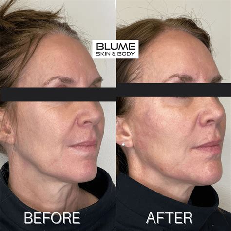 Dermal Fillers Before And After Photos Scottsdale Arizona