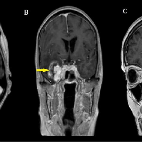 Cmri Mprage T Weighted A Axial B Coronal C Sagittal The